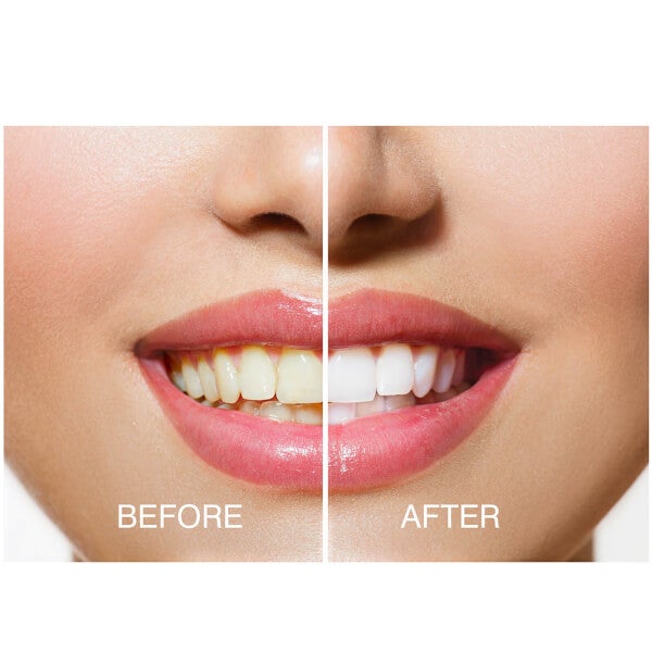 Rio Rio Smile White Advanced Teeth Whitening Kit Limitato a 3 giorni